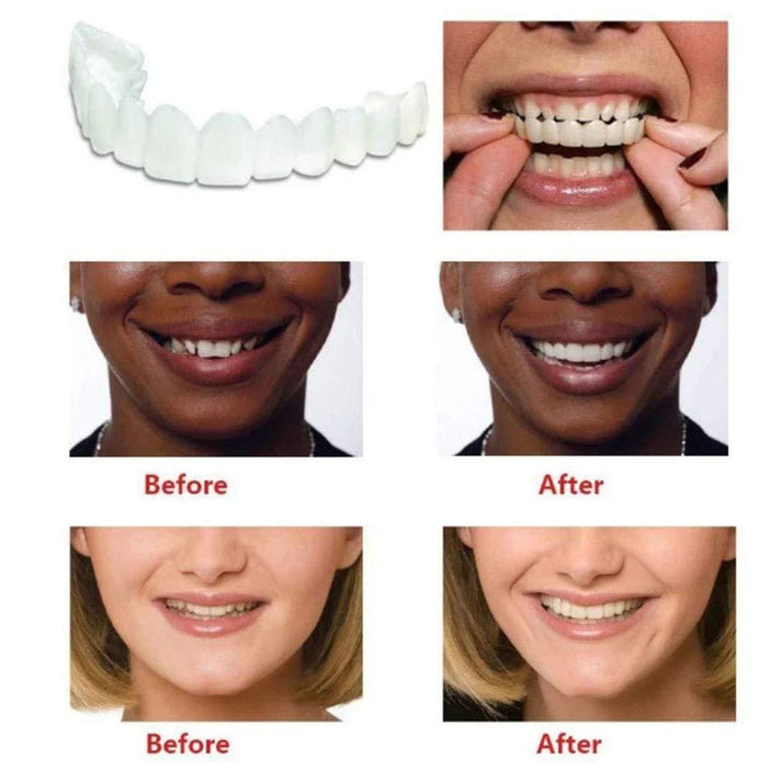 FIT FLEX ADJUSTABLE TEETH COVER (🔥Buy 1 Get 1 Free🔥)