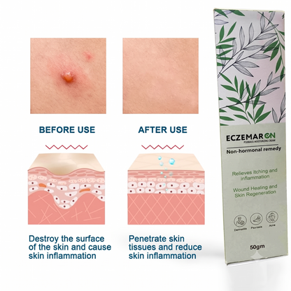 Herbal Psoriasis Eczema Relief Spray  (🔥Buy 1 Get 1 Free🔥)(Pack Of 2)